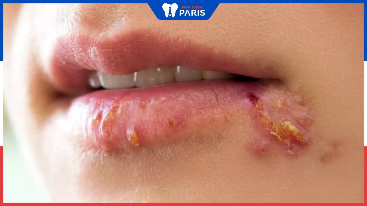 Hỏi đáp: Bệnh Herpes môi có nguy hiểm không